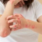 blisterata