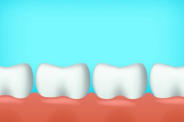 cavity between teeth